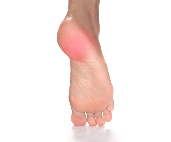 gout in heel of feet